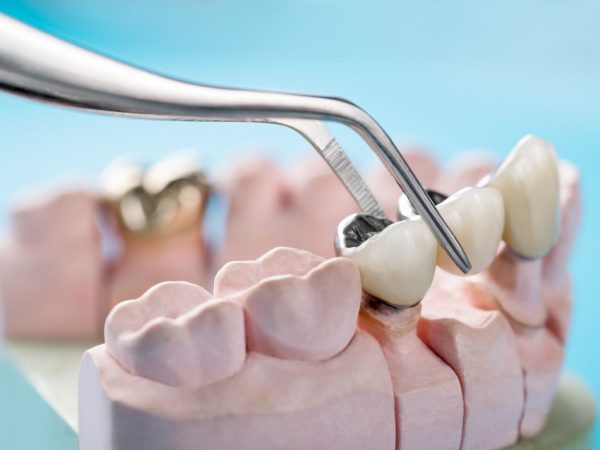 Niech twoje uśmiechy będą pewne i piękne dzięki nowoczesnym protezom zębowym!